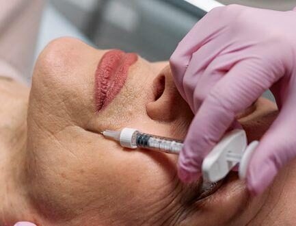 What Is the Best Filler for Marionette Lines? A Friendly Guide to Youthful-Looking Skin