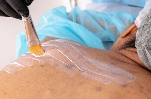 What Is the Best Skin Peel for Acne Scars? A Friendly Guide to Clearer, Smoother Skin