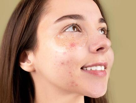 What Pimple Patches Are the Best for Clearer Skin and Fast Results